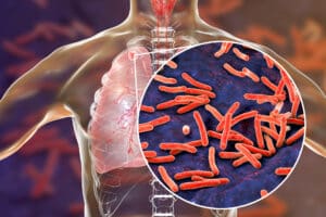 fibercel tuberculosis outbreak