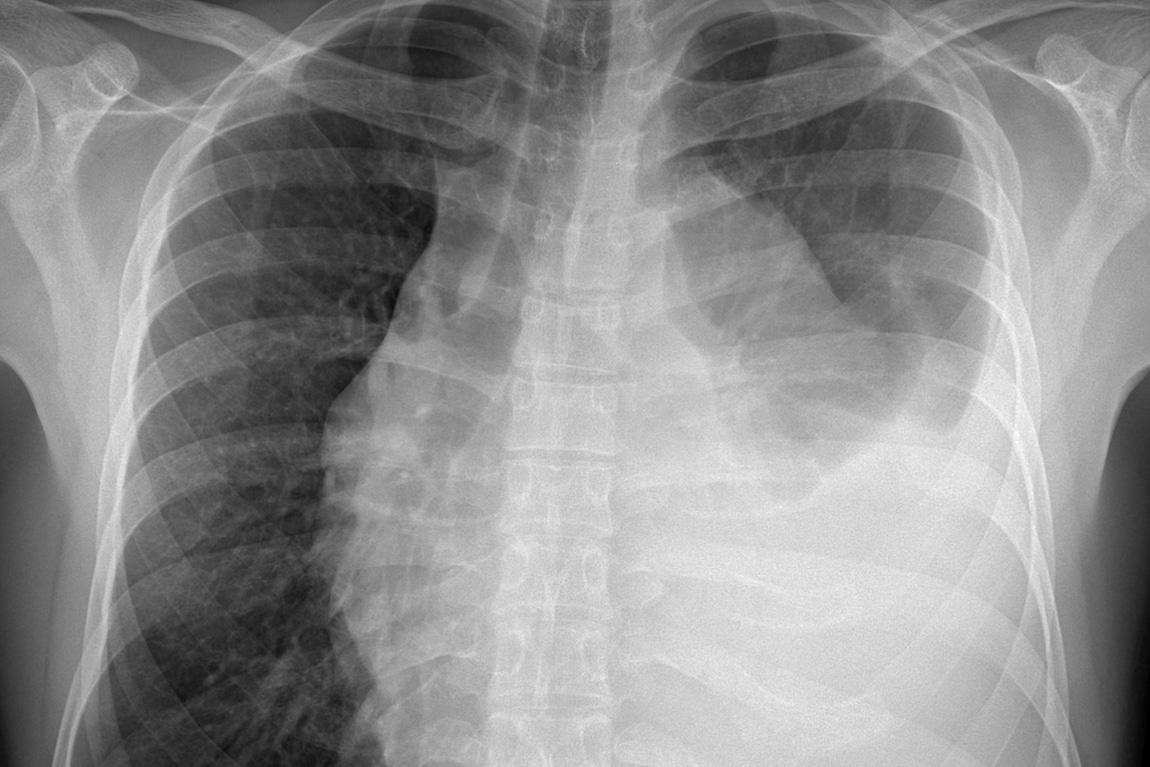 Car Accidents Can Cause Collapsed Lungs