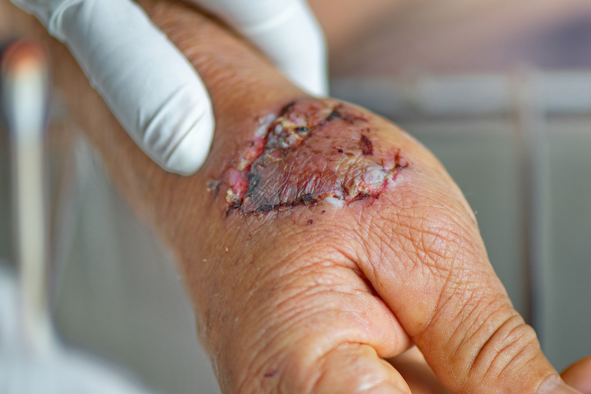 Dog Bites and Cellulitis